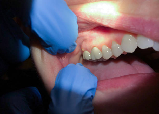 Best Emergency Dental Care for Broken or Chipped Teeth in Cedar Park, TX